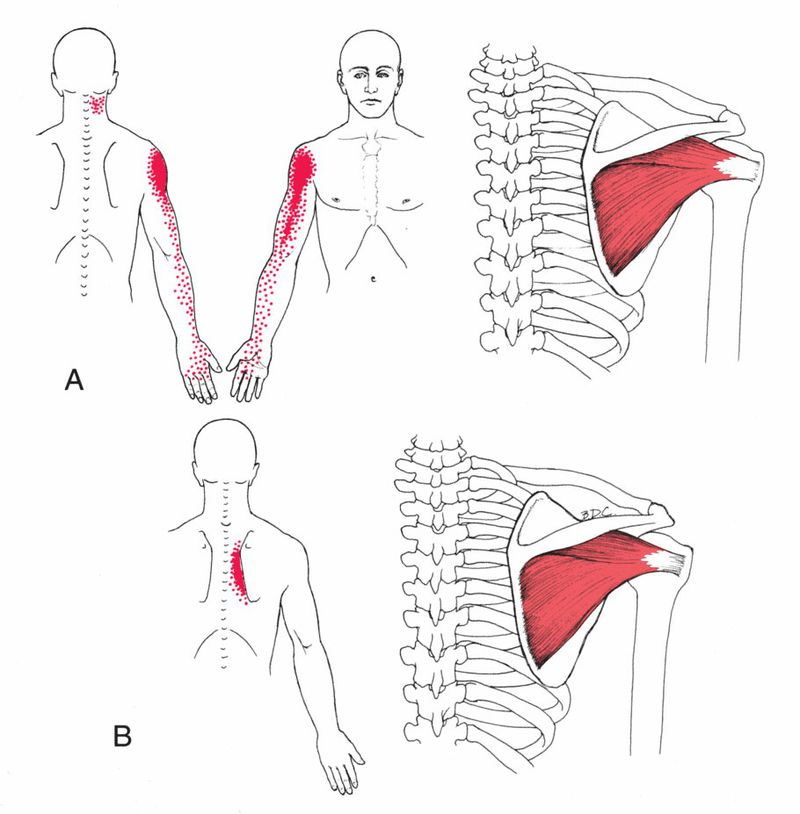 Infraspinatus - Afbeelding 2
