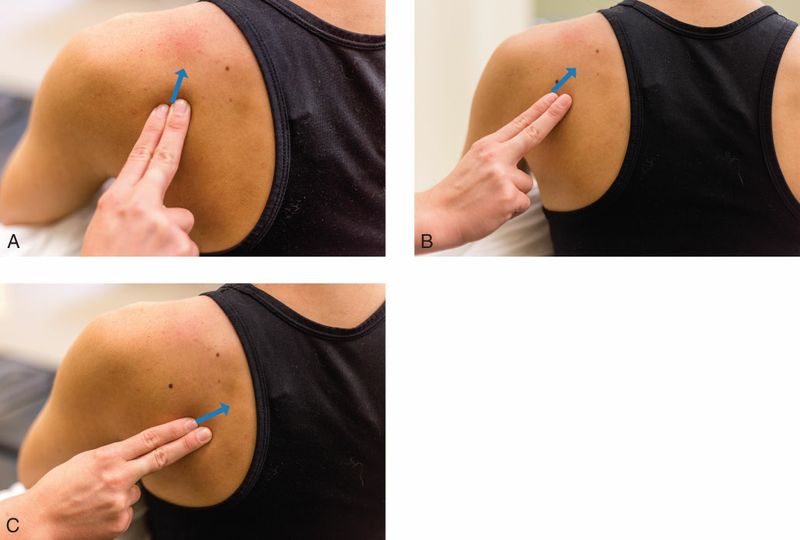 Infraspinatus - Afbeelding 3