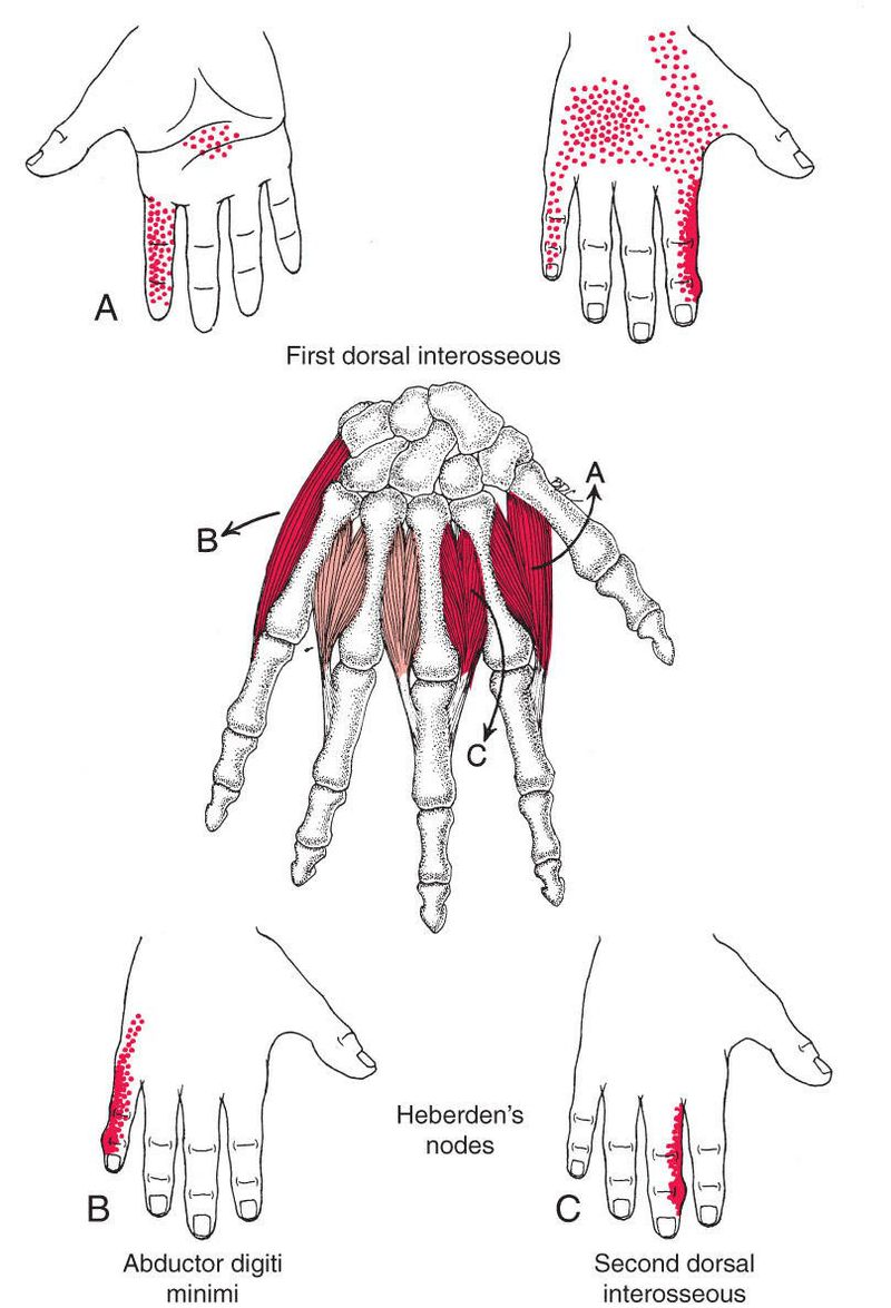 Interossei - Afbeelding 3