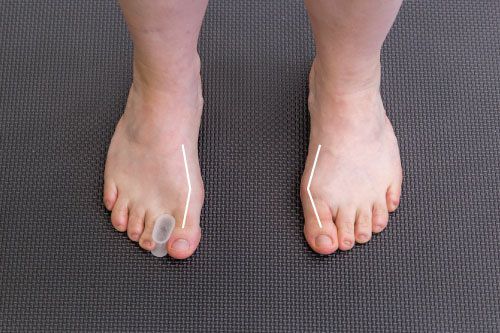 Intrinsieke Voetspieren - Afbeelding 14