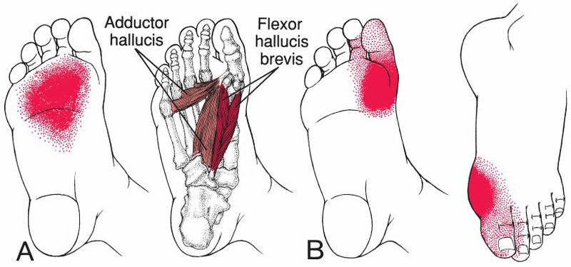 Intrinsieke Voetspieren - Afbeelding 7