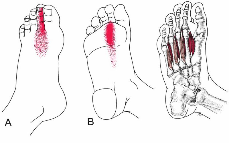 Intrinsieke Voetspieren - Afbeelding 8