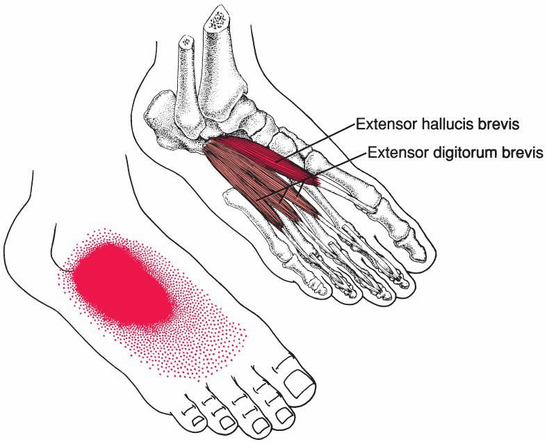 Intrinsieke Voetspieren - Afbeelding 9