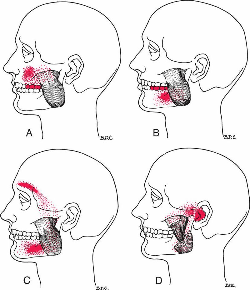 Masseter - Afbeelding 2
