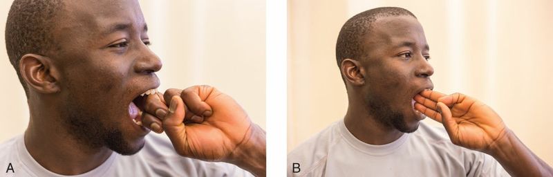 Masseter - Afbeelding 3