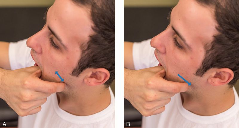 Masseter - Afbeelding 5