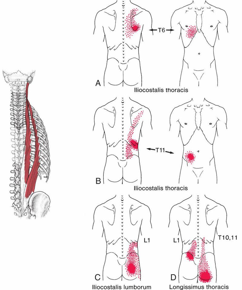 Paraspinale Spieren - Afbeelding 3
