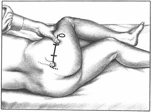 Piriformis - Afbeelding 6