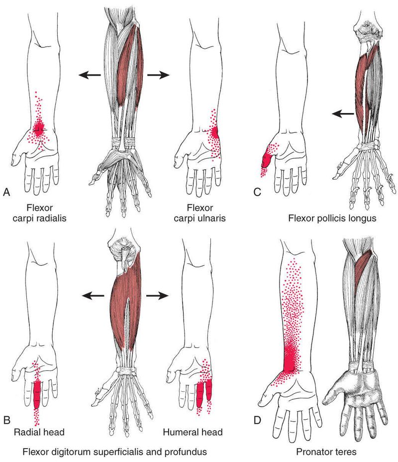 Polsflexoren - Afbeelding 3