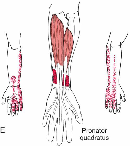 Polsflexoren - Afbeelding 4