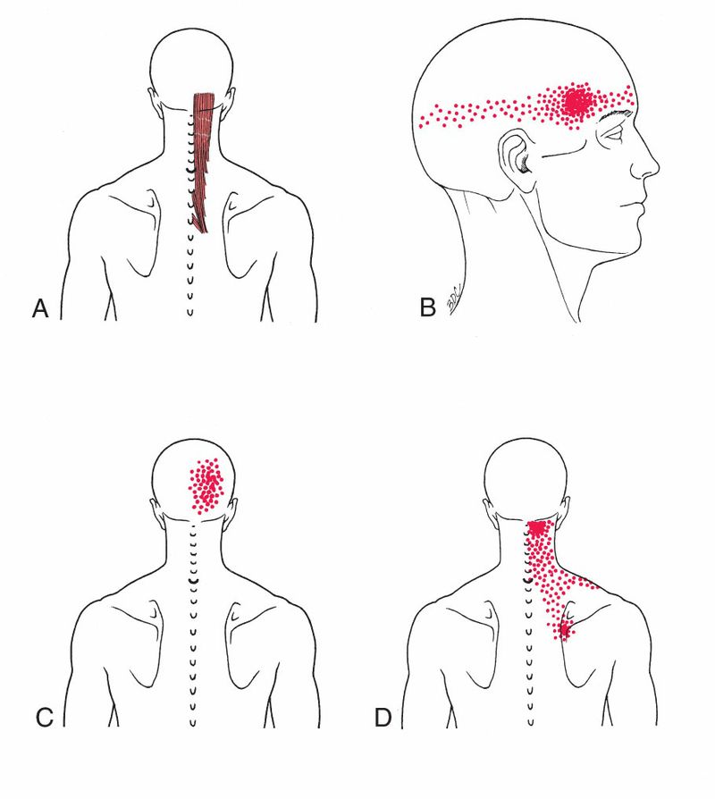 Posterieure Nekspieren - Afbeelding 4