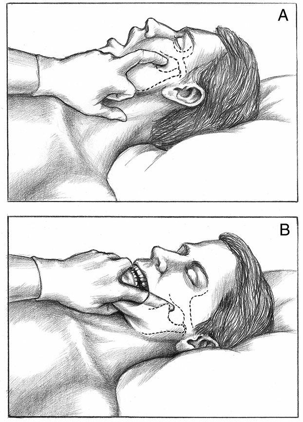 Pterygoideus Lateralis - Afbeelding 4