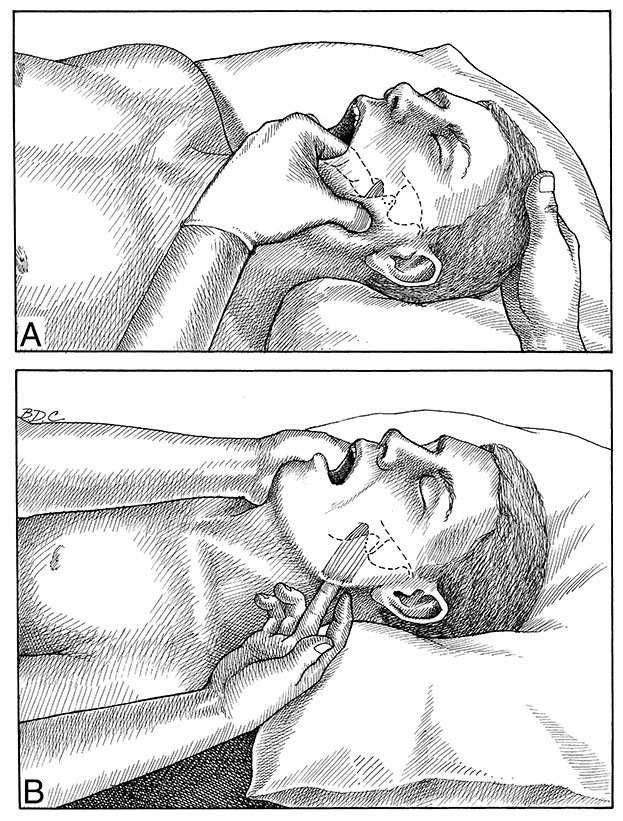 Pterygoideus Medialis - Afbeelding 3