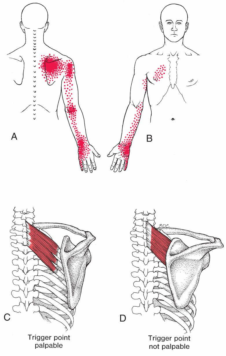 Serratus Posterior - Afbeelding 4