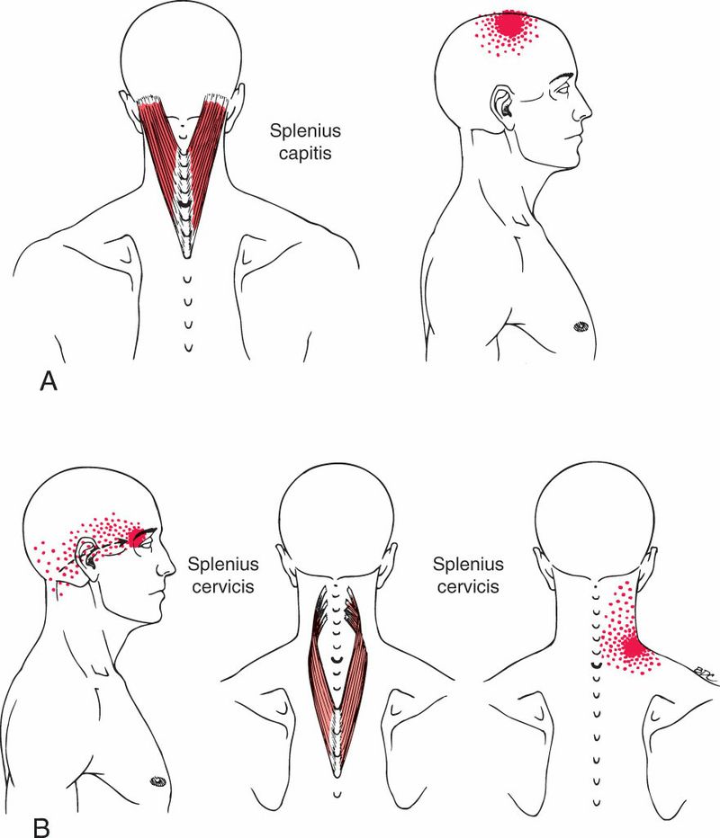 Splenius Cervicis - Afbeelding 2