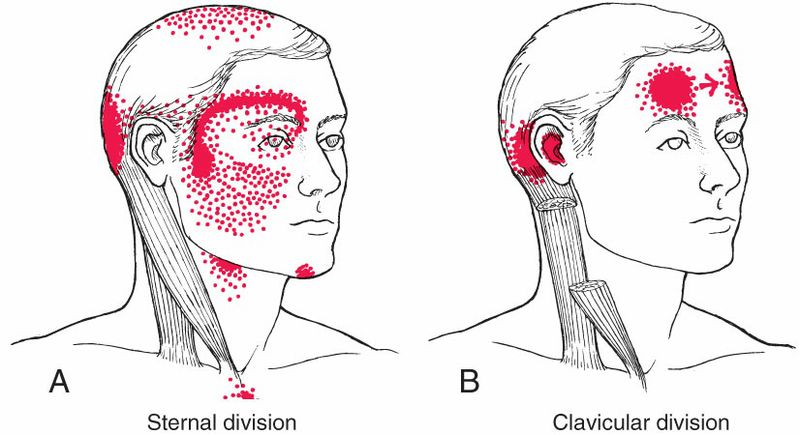 Sternocleidomastoideus - Afbeelding 2