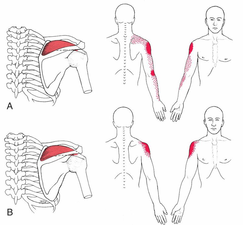 Supraspinatus - Afbeelding 2
