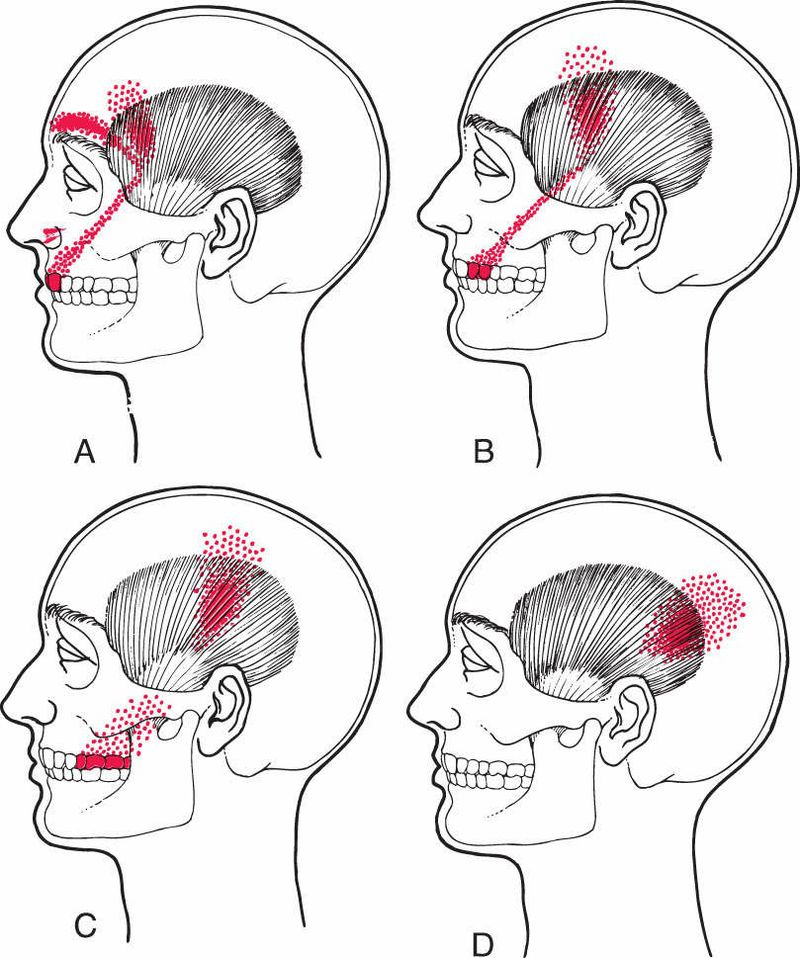 Temporalis - Afbeelding 2