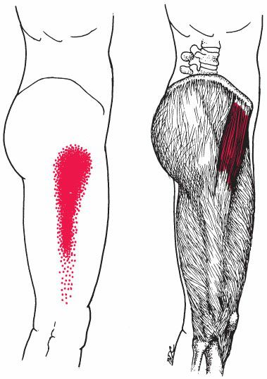 Tensor Fasciae Latae - Afbeelding 5