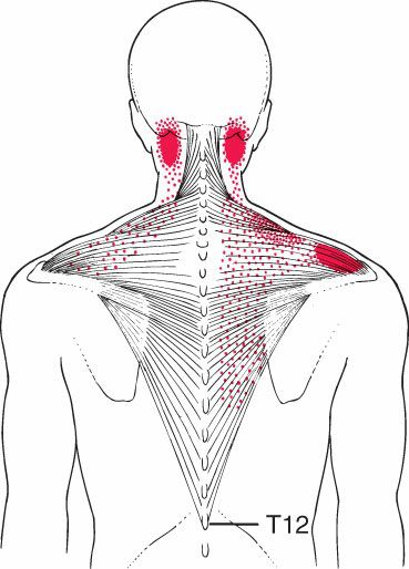 Trapezius - Afbeelding 5