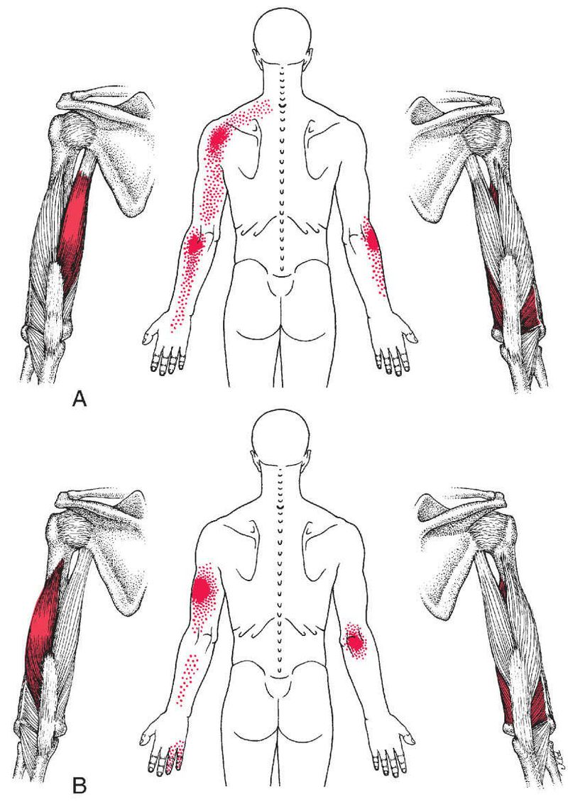 Triceps Brachii - Afbeelding 3