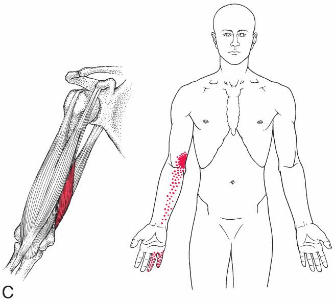 Triceps Brachii - Afbeelding 4